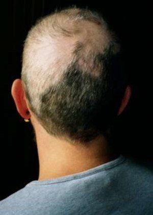 Male anus hair loss