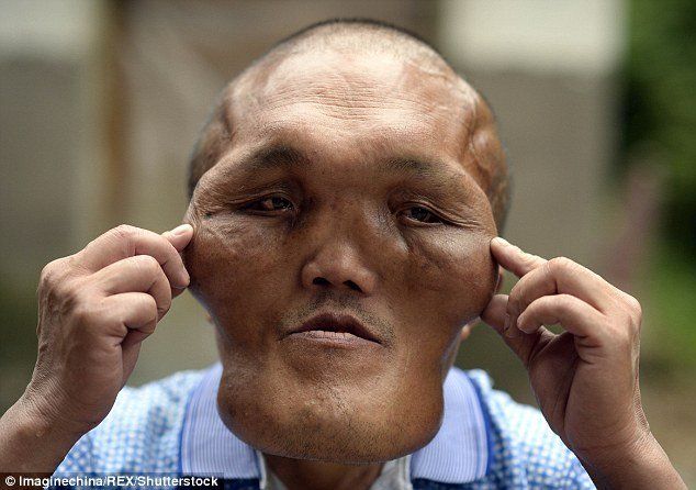 Pictures of facial deformaties