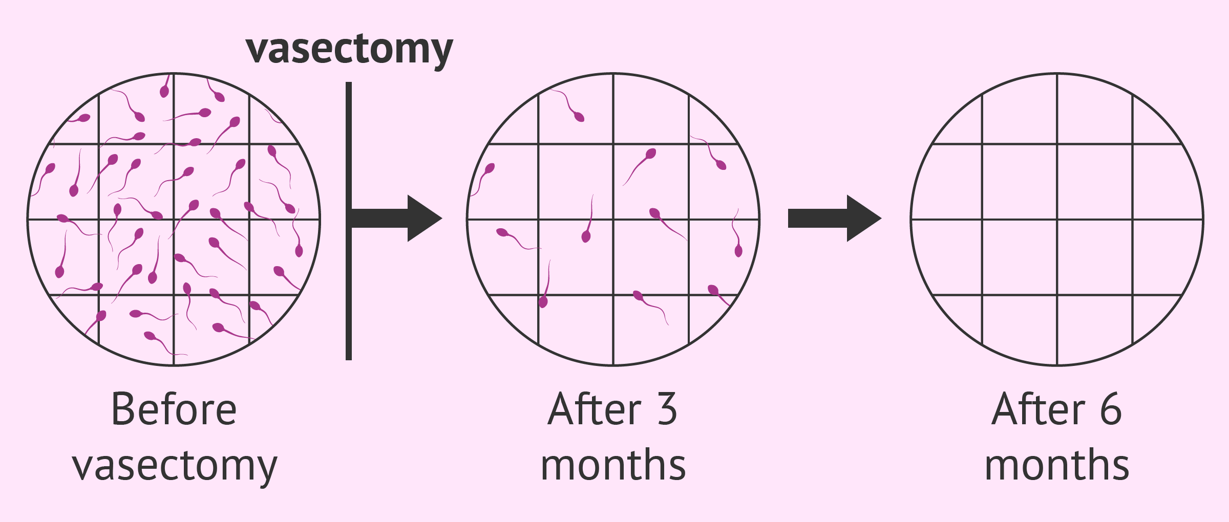 Post vasectomy sperm counts