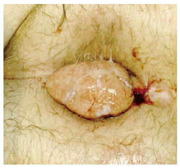 Squamous cell carcinoma of the anus