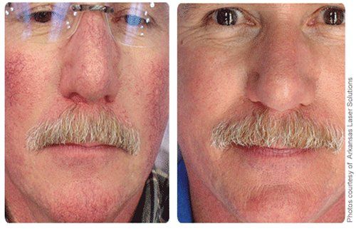 best of Facial Treatments for spider veins
