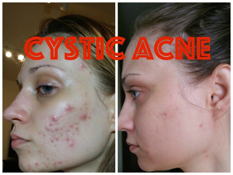 Hose reccomend Zinc oxide ointment for facial scar